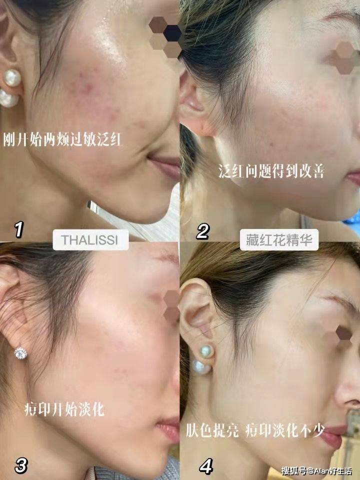 娇兰VTN之家：你还在随意使用精华吗？大牌测评，敏感混油肌专题