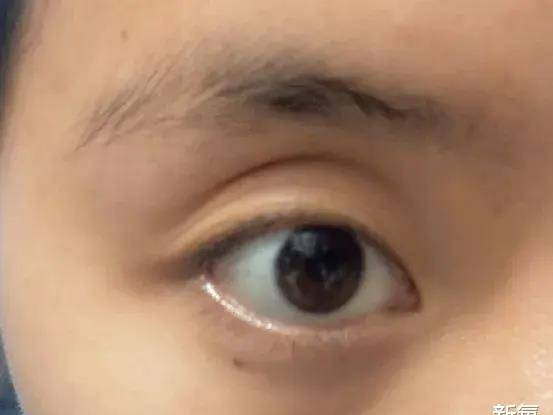 眉骨患11天痊愈后的Lisa，怎么完全认不出了…