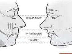 什么警惕：做线雕会不会有什么后遗症？做完线雕10几天下垂了咋整?