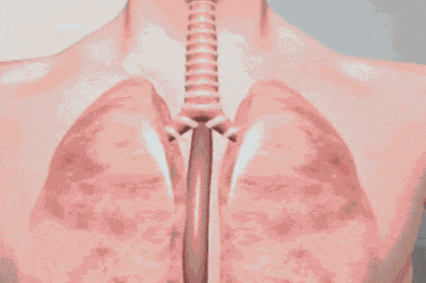 黏液|专家共识:气道廓清呼吸康复治疗,推荐西纳舒盐溶胶治疗仪