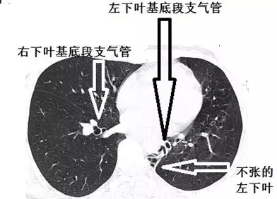 正常的左下葉基底段支氣管,內前,外,後基底段支氣管,應該是張牙舞爪