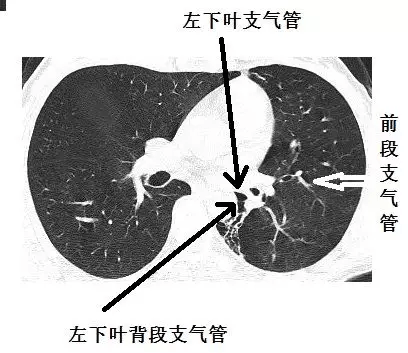 圖13-15▼左下葉支氣管的分支:各基底段支氣管,他們都萎靡不振,蜷縮在