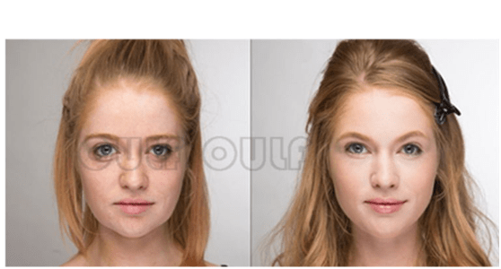 脸部浅谈脸部下垂做线雕好还是拉皮好、脸部做线雕有副作用吗?