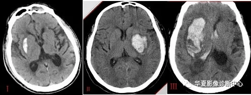 不同部位脑出血的表现_动脉_artery_分支