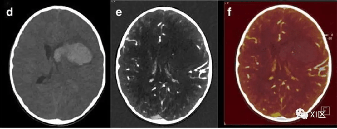 ct圖像中腦出血血腫擴大的十個徵象下