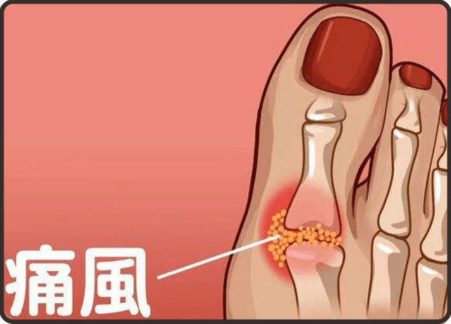 肾脏|痛风也要及时治疗，小心出现痛风性肾病！