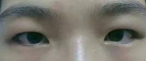 双眼皮|北京西美刘野院长：如何做到肿眼泡做双眼皮避免出现肉条感