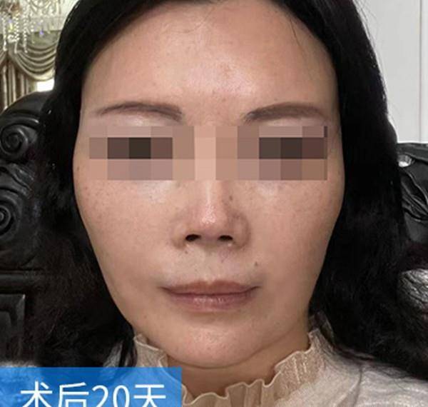 脸部拉皮术后20天记录：从松弛大妈到年轻小姐姐，我经历了什么？