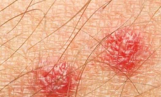 红斑|皮肤上出现这种红斑，最好别大意，可能“坏”细胞在慢慢靠近胰腺