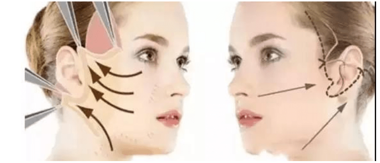 什么科普篇：ppdo线雕是什么线？ppdo线雕维持时间？