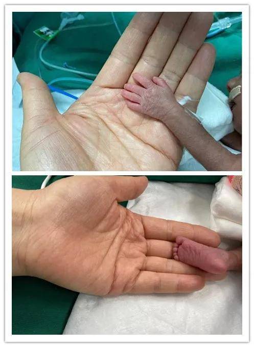 挑战极限,先后为超早产双胞胎姐妹(胎龄仅27周)成功实施动脉结扎手术