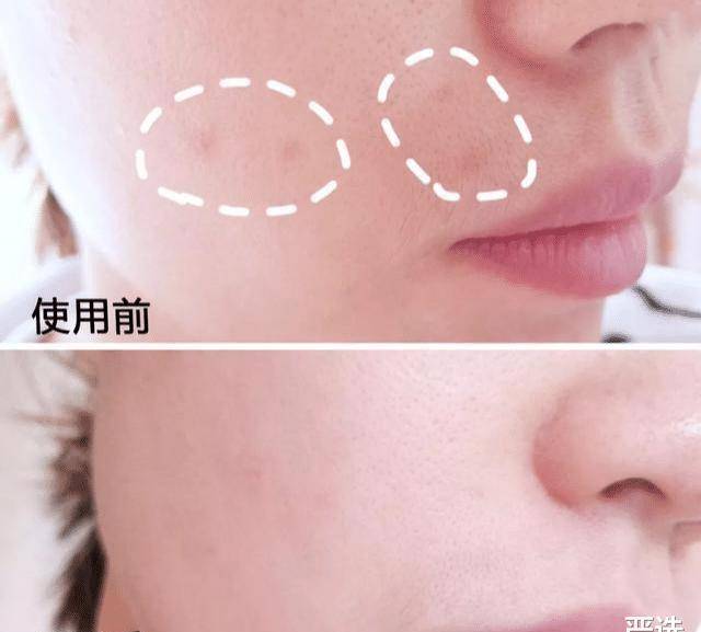 品牌继注射“玻酸”后，又一“抗衰老”方式走红，即安全还方便