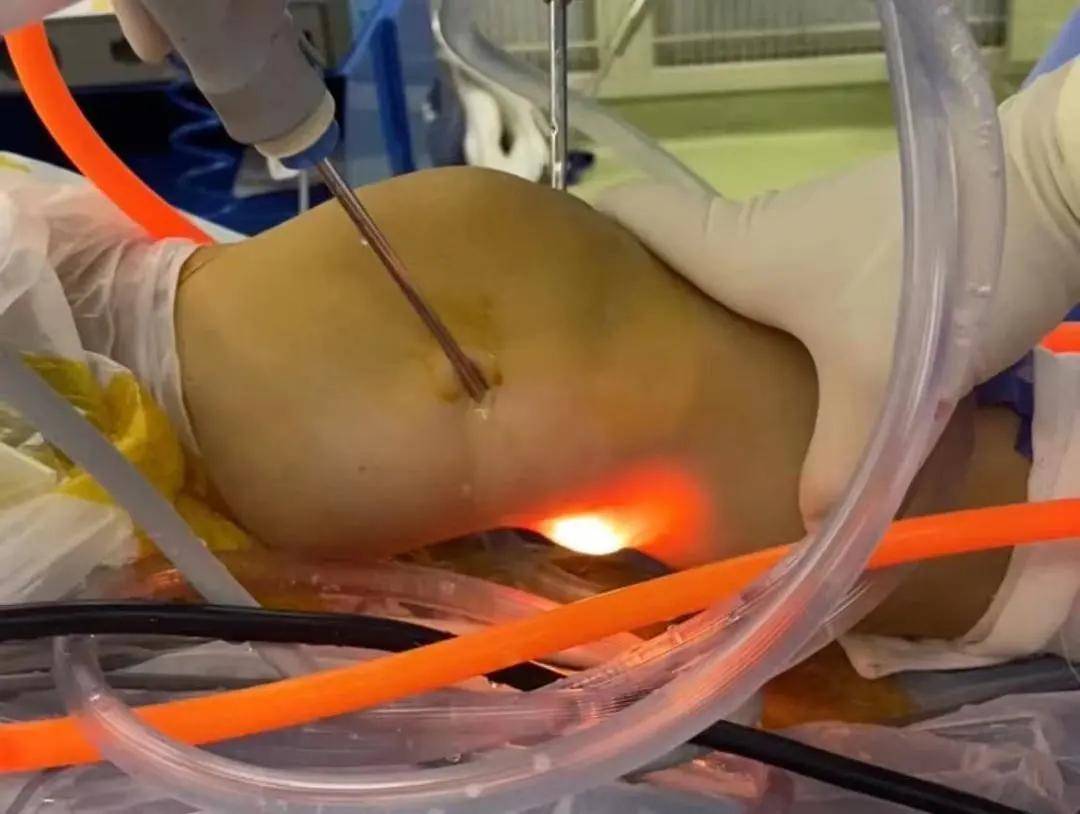 腿弯长了个包小心是腘窝囊肿