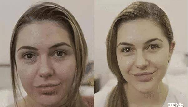 品牌继注射“玻酸”后，又一“抗衰老”方式走红，即安全还方便