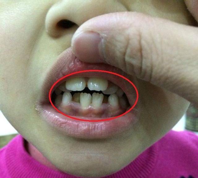 孩子换牙期常见的3大问题家长早发现娃少受罪或者不受罪