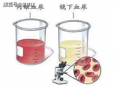 血液|尿出现这几个变化，肾可能出问题了？