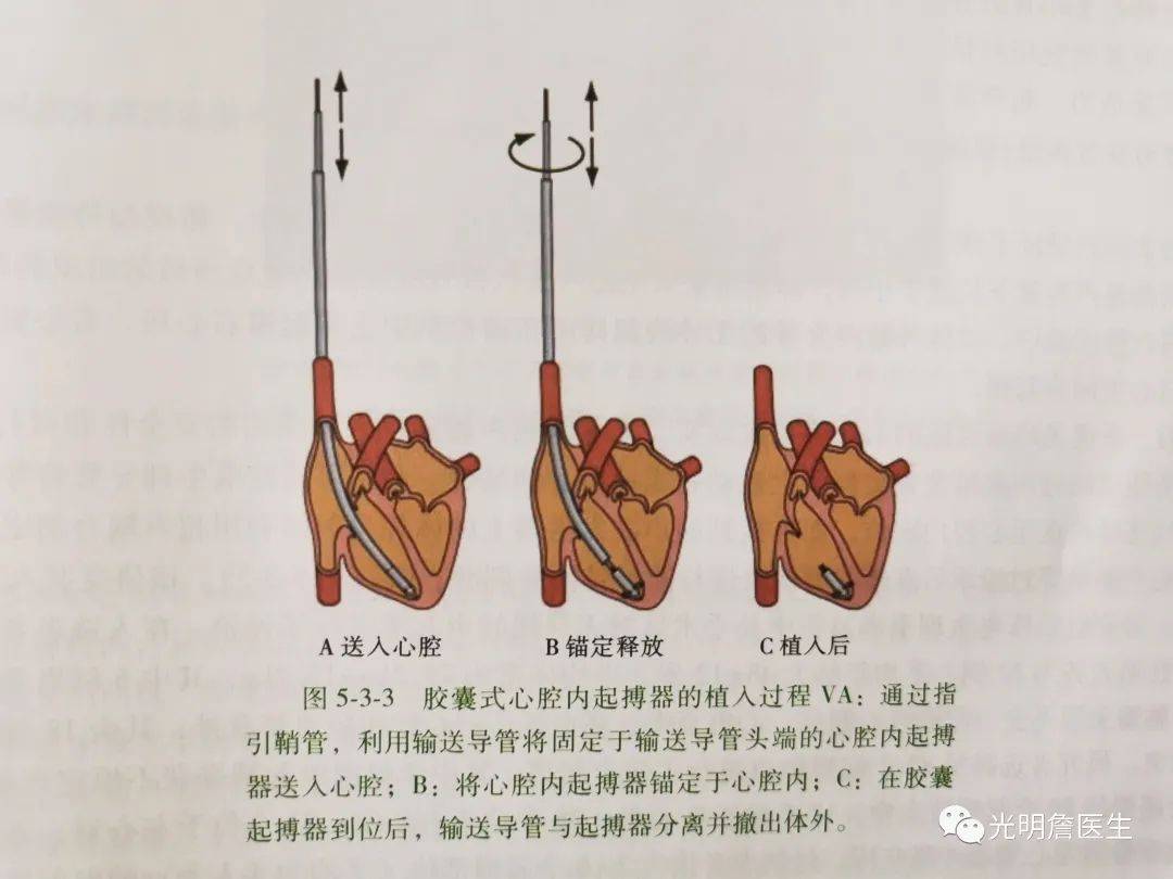 胶囊大小的心脏起搏器您见过吗