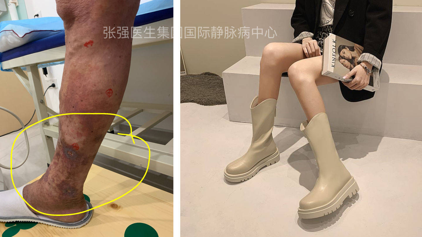 静脉曲张导致小腿皮肤湿疹都抓出血了 能治吗 治疗 皮炎 医生