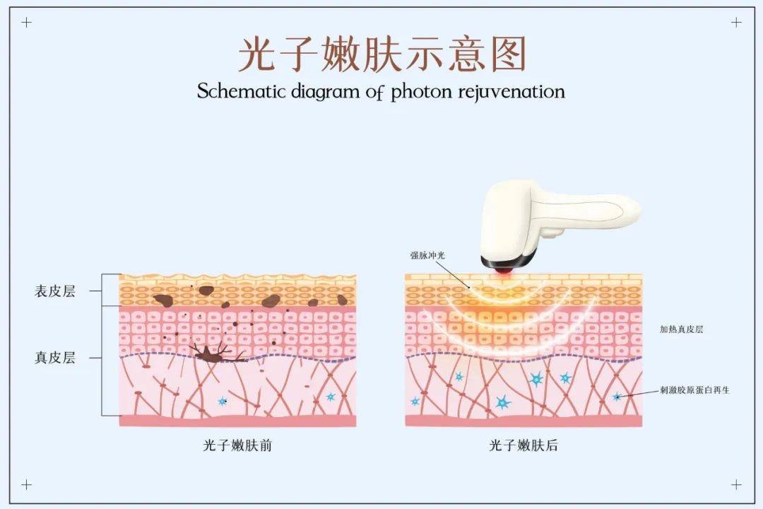 治疗医美科普 | 光子嫩肤适应症与主要事项