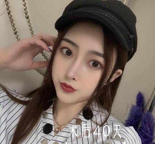 女士贷款2万6隆鼻，手术失败成怪物，人财两空风险下，还有人趋之若附