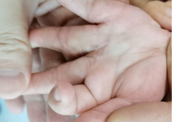 全性|顺德和平医院手指再造：宝宝并指需要做几次手术