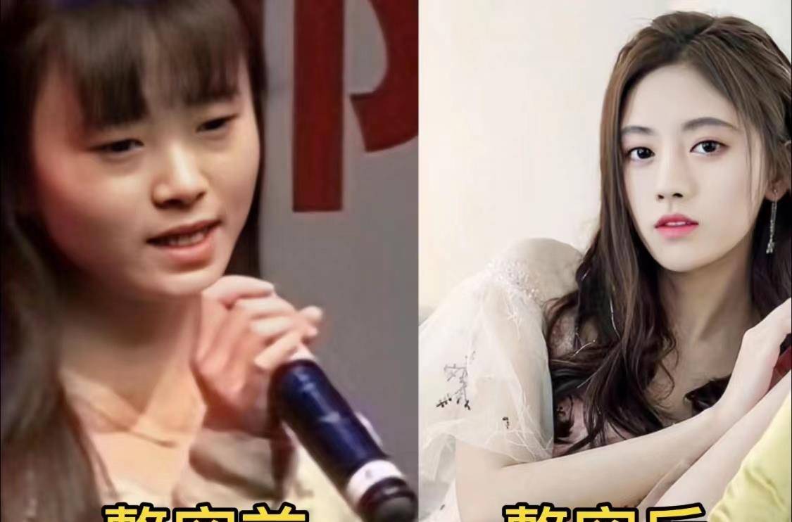 后遗症女明星为了变美，乱整鼻子留下的后遗症，至今悔恨终身