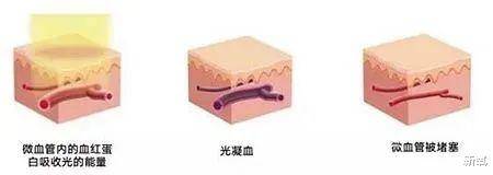 血管比姨妈来得还准的春季综合症,烂脸还算是轻微的?