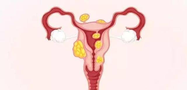 女人怎么会长子宫肌瘤 07e507e805b246fdacac5ac7331afbf4.jpeg