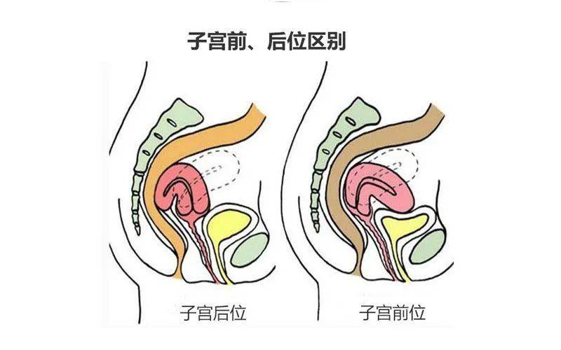 发育不良的子宫,每次姨妈期都会因子宫颈口狭窄或子宫位置倾斜而造成
