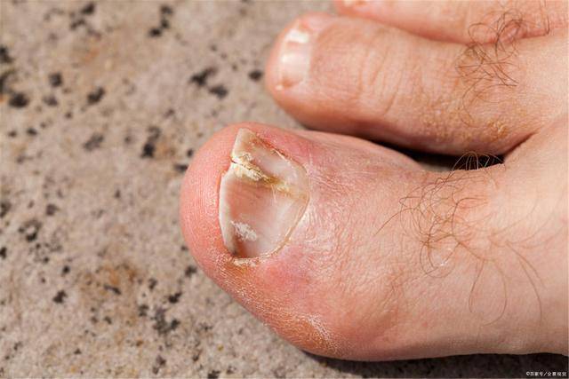 原创肝不好脚先知若脚上出现这5种状况表明您的肝越来越不好了