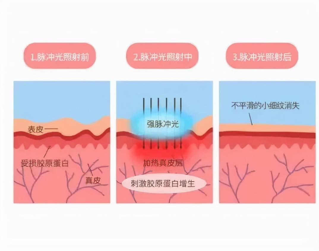 治疗敏感肌分几种类型？敏感肌如何治疗？