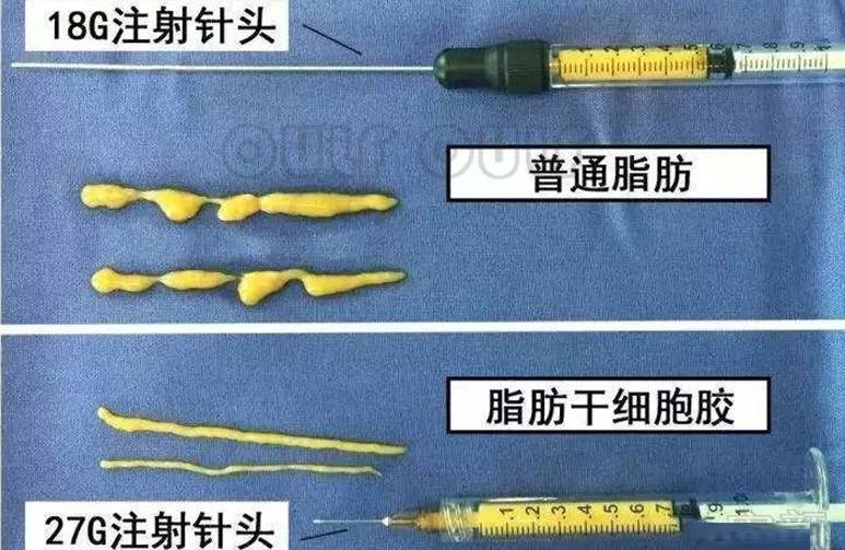 米脂纳米脂肪胶填充能维持多久？脂肪胶填充成活率高吗？不看后悔！