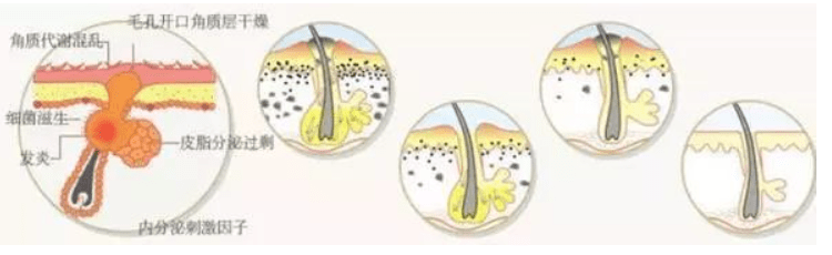进行用了护肤品长痘是怎么回事呢？快来看看真相是什么