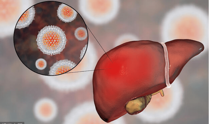 肝脏|促使肝脏硬化的4个因素，希望你都没有，6种食物帮助保护肝脏健康