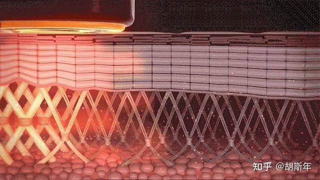 mm7d聚拉提做一次有效果吗、7d聚拉提做脸大概多久有效果、看懂了!