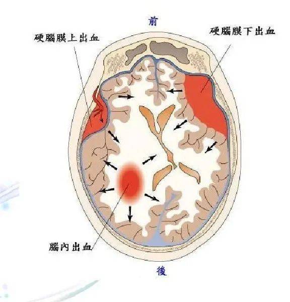 硬膜下血腫根據發生時間,可分為急性硬膜下血腫(傷後3天以內),亞急性