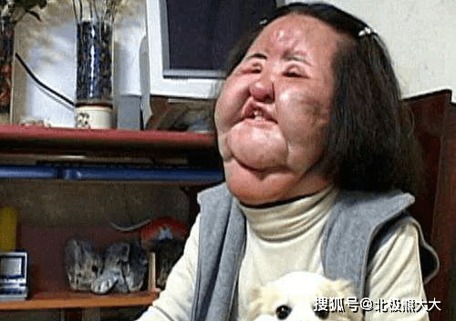 因为痴迷整容15年，把脸整成“电风扇”后遗症明显，韩慧景后悔了吗？