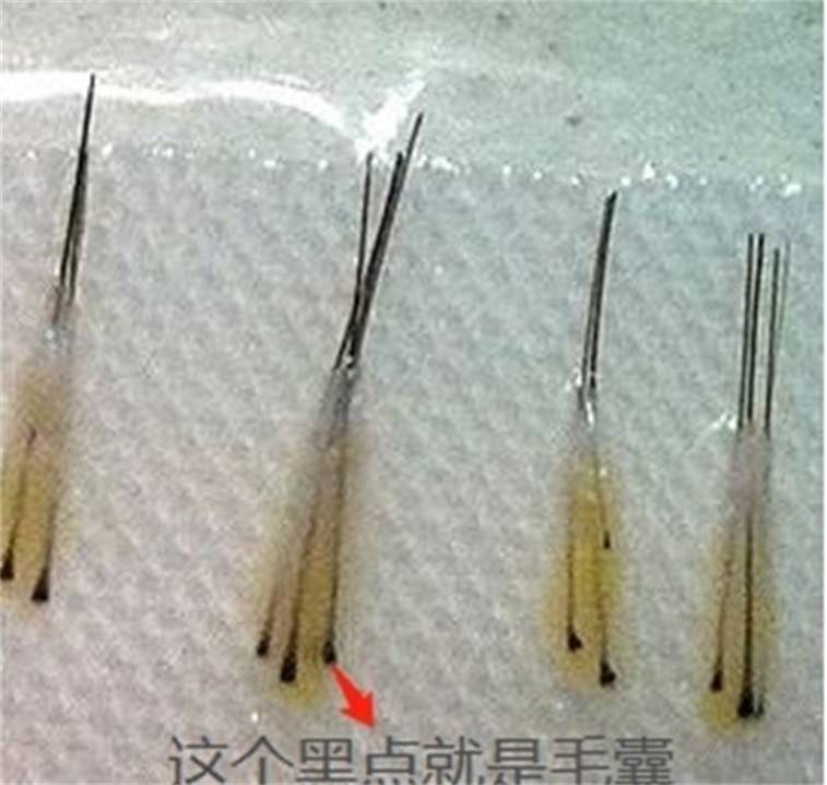 进行妈呀植发效果怎么样：植发脱落期持续多久？真相了~