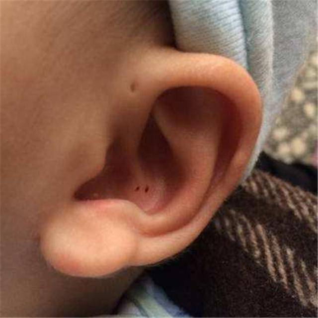 婴儿耳朵有个小眼图片图片
