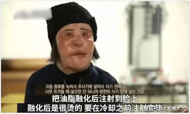 因为痴迷整容15年，把脸整成“电风扇”后遗症明显，韩慧景后悔了吗？