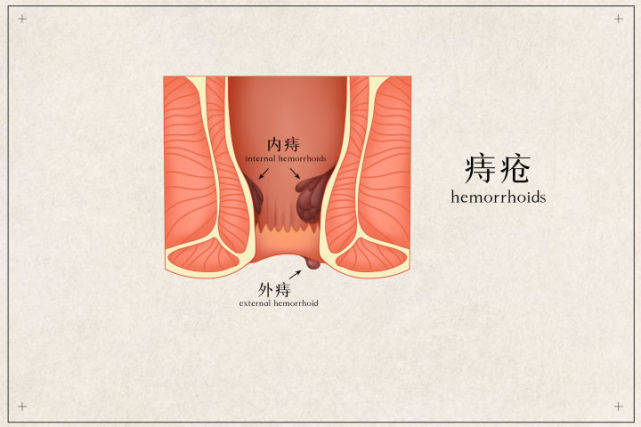 怎么让痔疮肉球缩回去?