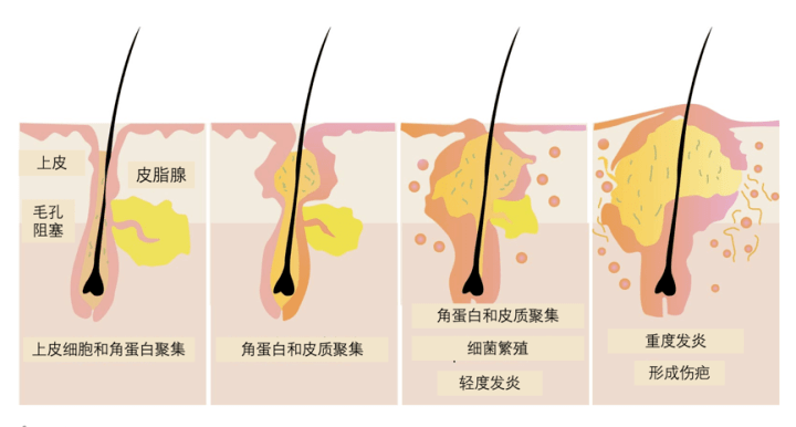 什么痘痘长得多怎么办？