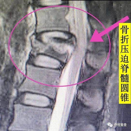 患者胸12爆裂骨折 脊髓受压,脊髓损伤asia分级c级,双下肢活动障碍