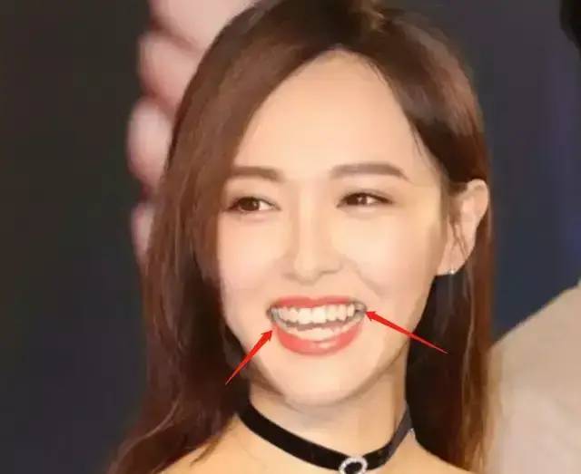 脸部明星整牙后遗症：杨幂脸部松弛，王嘉尔颧骨外扩，宋祖儿法令纹深！！