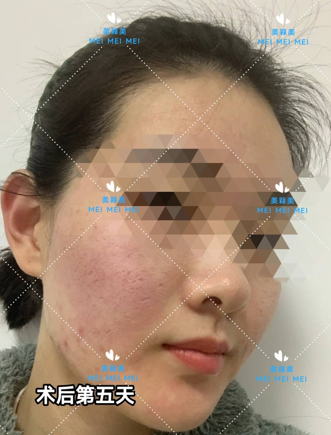 差不多【美人汇】痘痘肌少女的逆袭之路