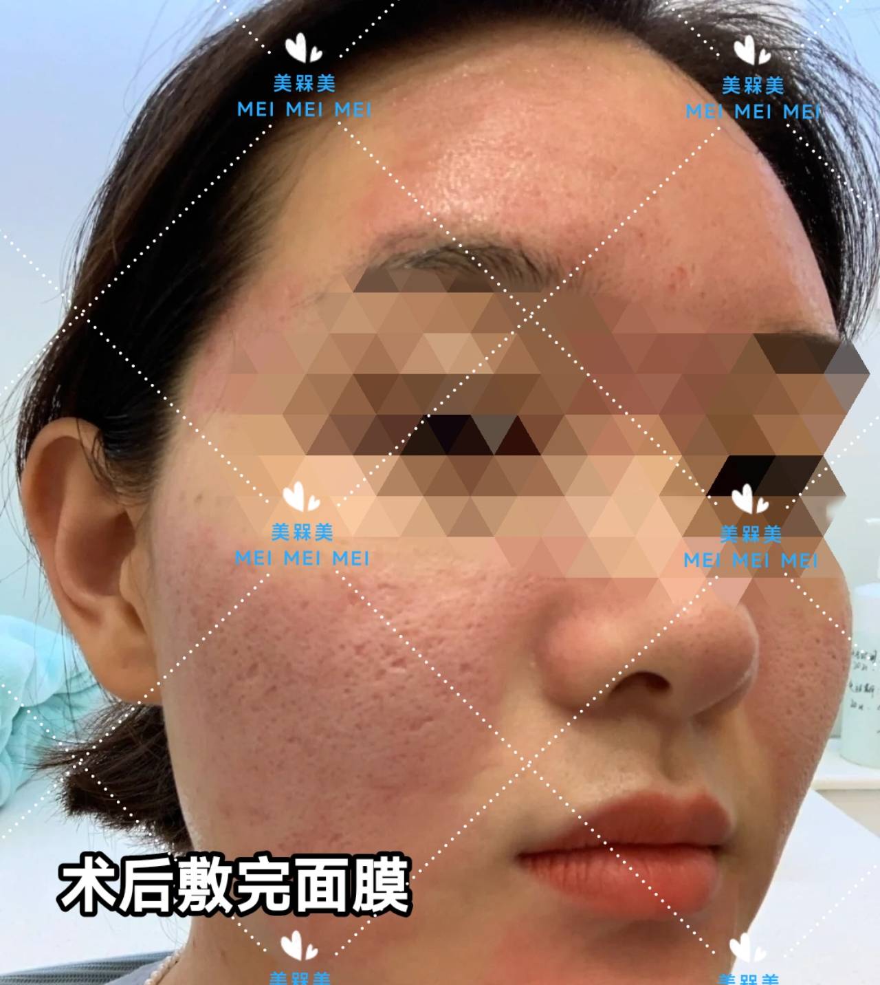 差不多【美人汇】痘痘肌少女的逆袭之路