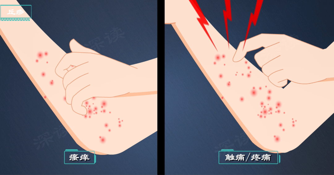 原创身上长痘痘小脓疱没事超短裙谁穿谁尴尬毛囊炎究竟是个啥