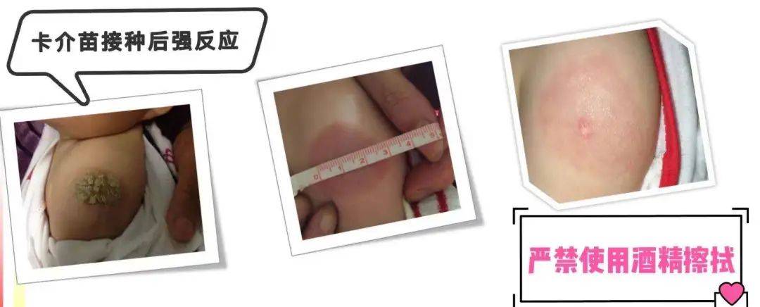 宝宝出生后为什么要接种乙肝疫苗和卡介苗?