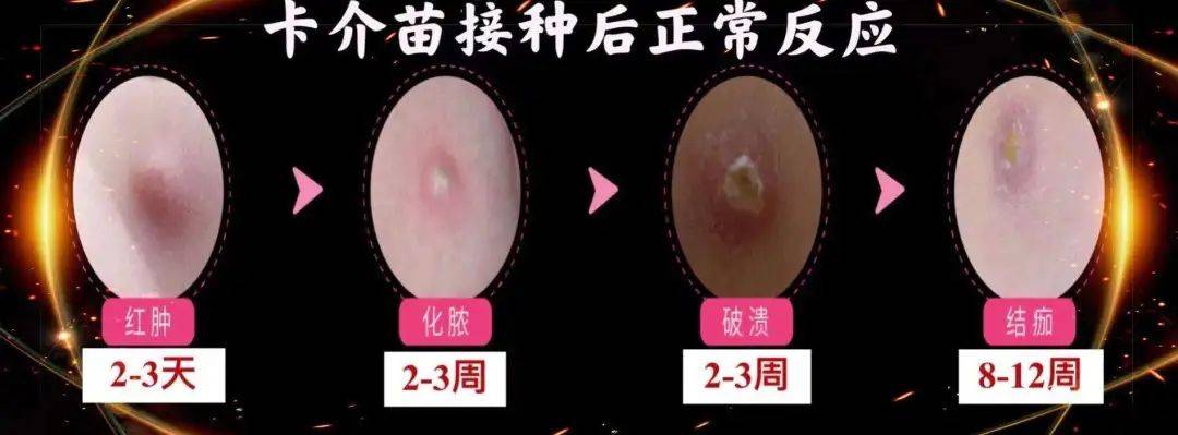 宝宝出生后为什么要接种乙肝疫苗和卡介苗?