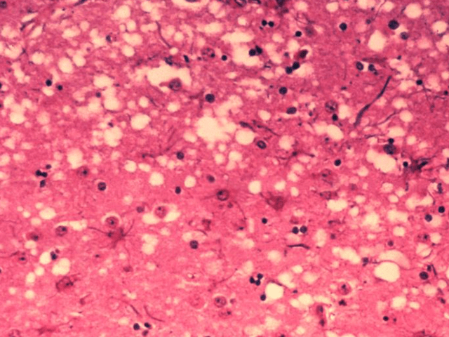 烹煮杀不死无药可救的朊病毒,感染后有多恐怖?_大脑_蛋白质_生物